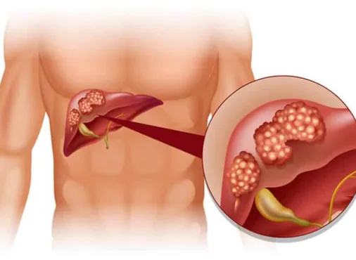Liver Cyst consultation at Niraaya Hospital